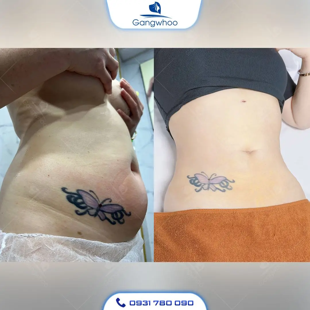 Hình ảnh khách hàng hút mỡ