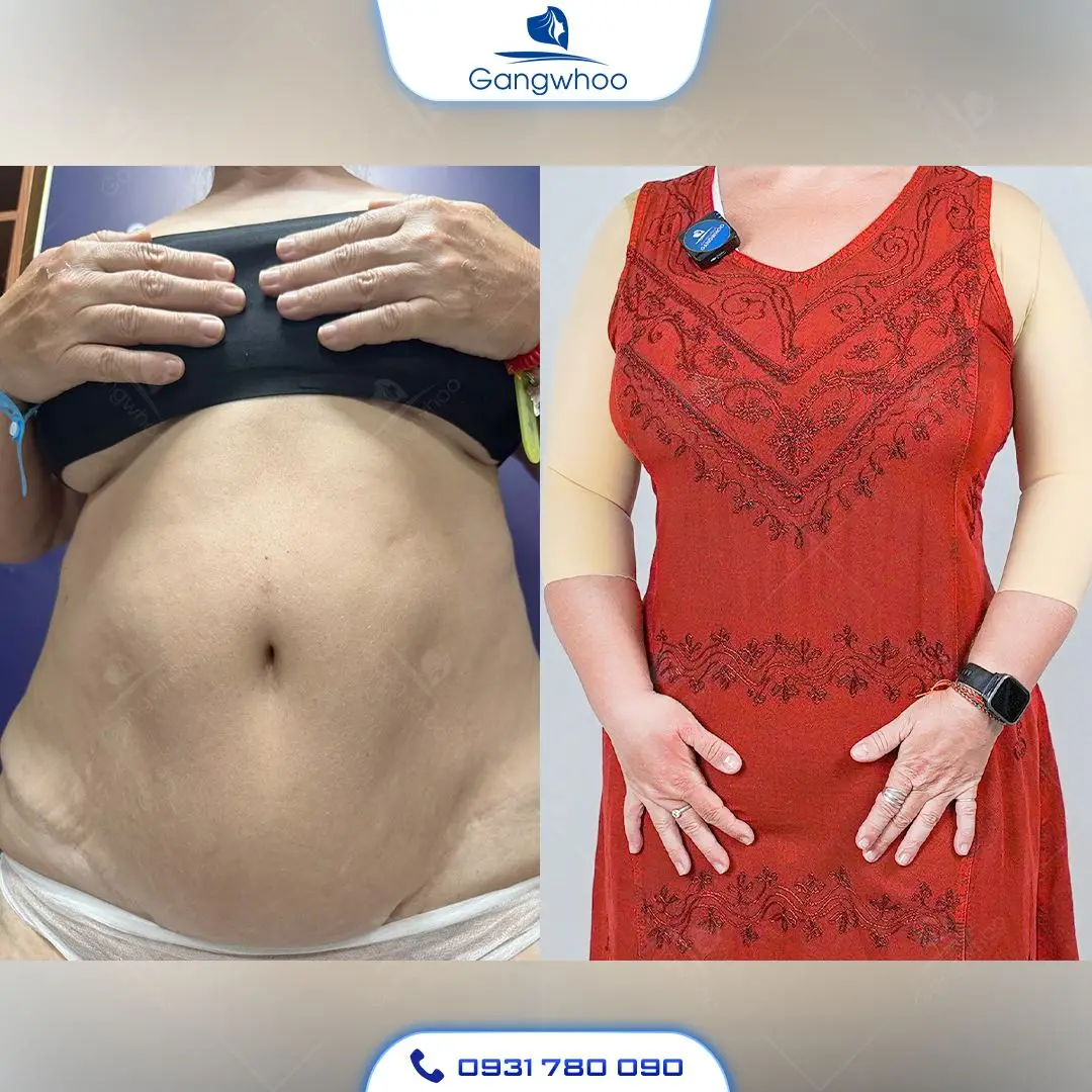 Hình ảnh khách hàng hút mỡ