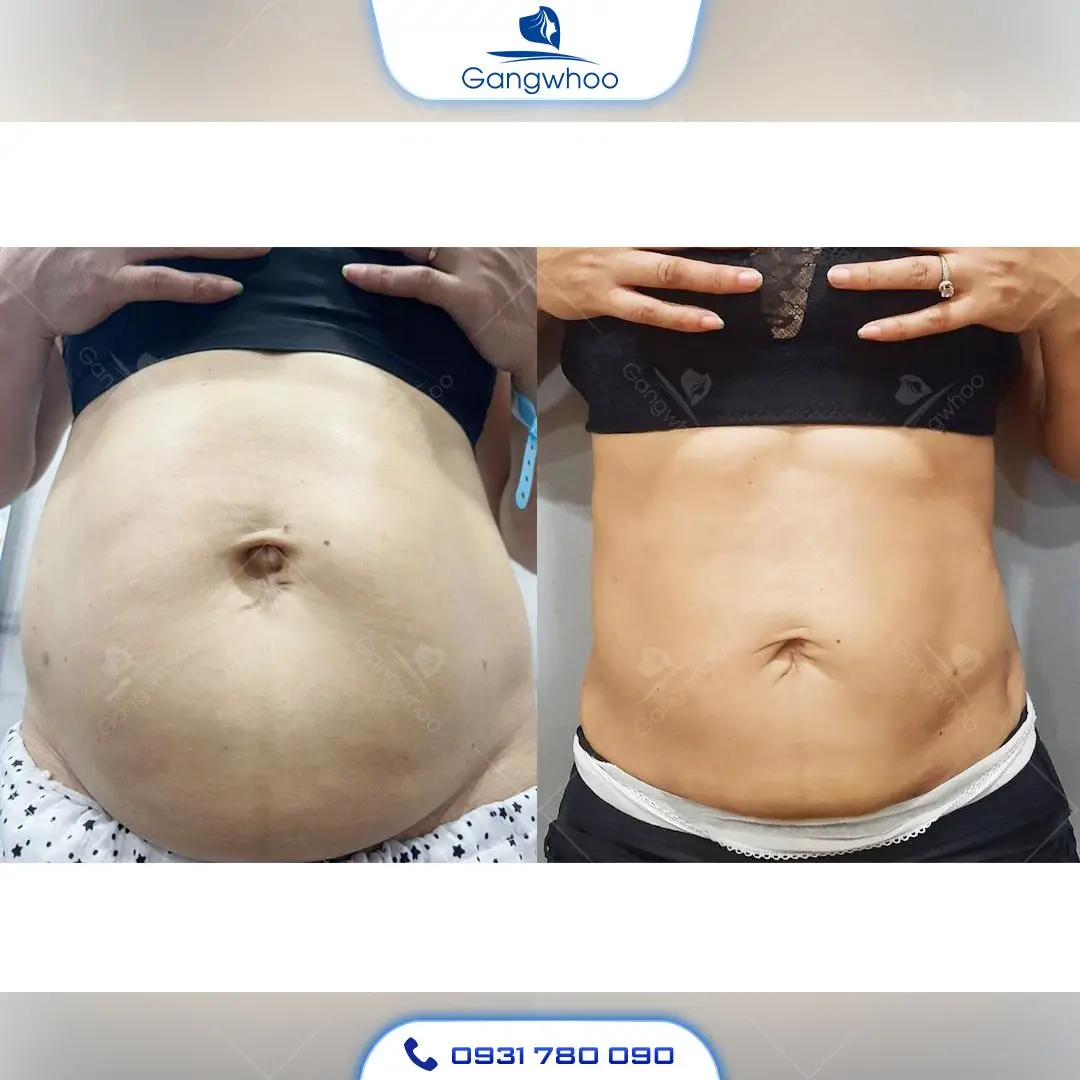 Hình ảnh khách hàng hút mỡ