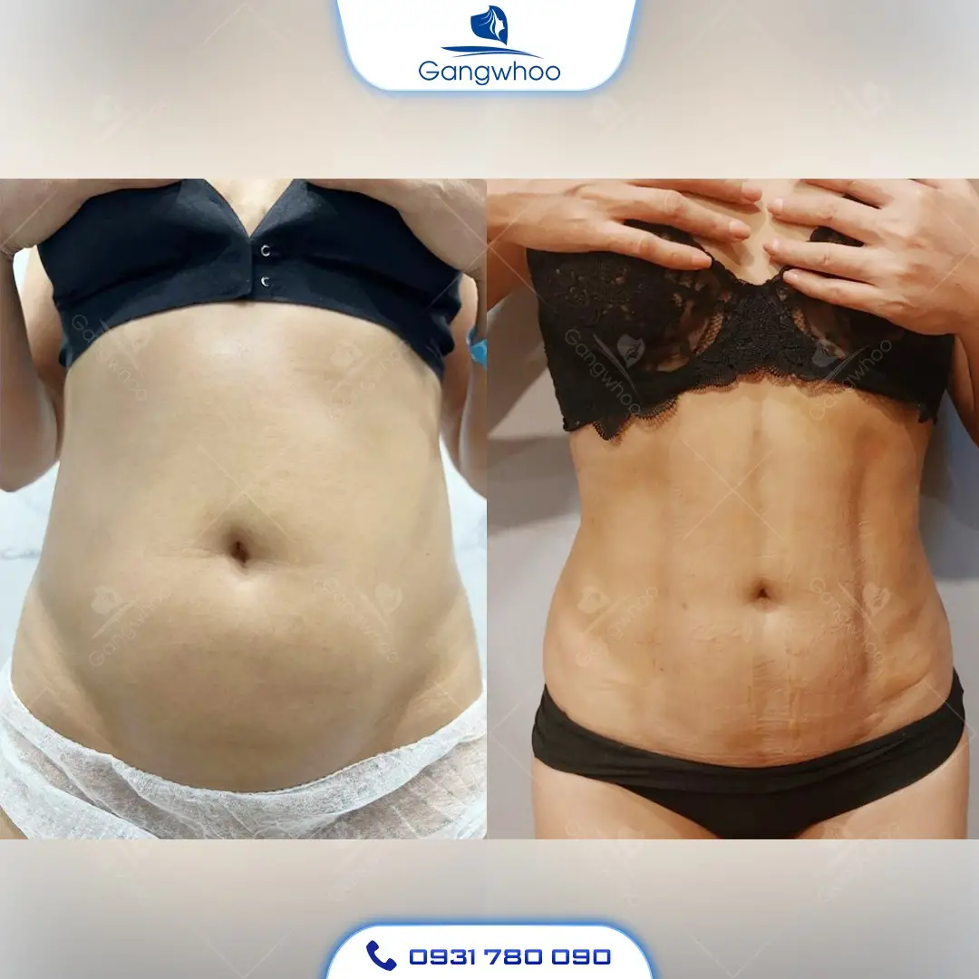 Hình ảnh khách hàng hút mỡ