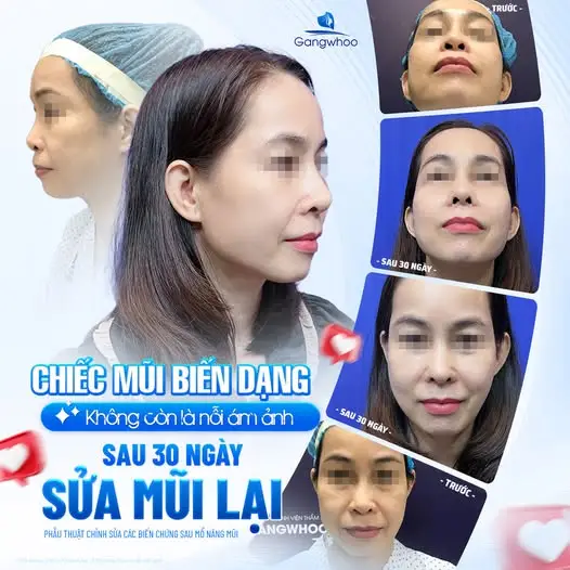 Vì sao nên cẩn thận với món canh cua đồng sau nâng mũi?