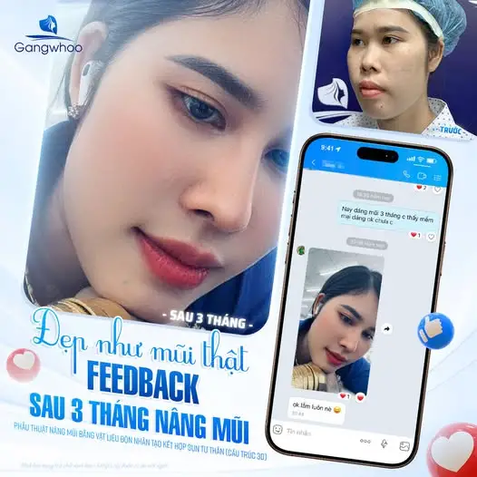 Sau nâng mũi bao lâu có thể ăn canh cua?