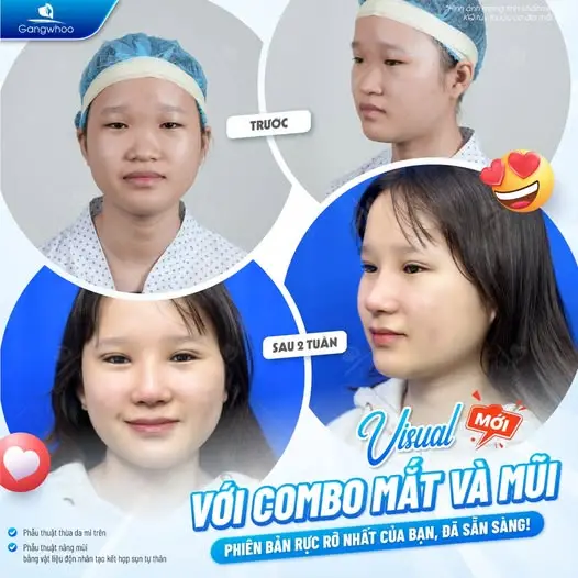 Vì sao dưa hấu thường được nhiều người lựa chọn sau khi nâng mũi?