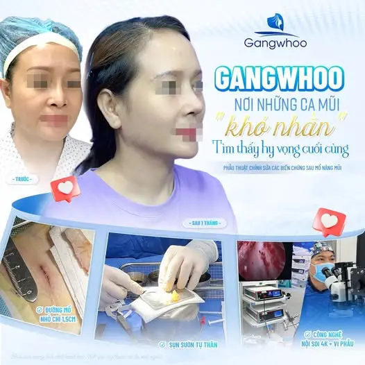 Thẩm mỹ viện Gangwhoo hiện là một trong những địa chỉ được nhiều khách hàng quan tâm nhờ ứng dụng công nghệ nâng mũi hiện đại