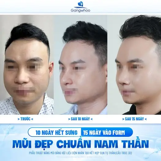 Những thực phẩm nên ưu tiên sau nâng mũi