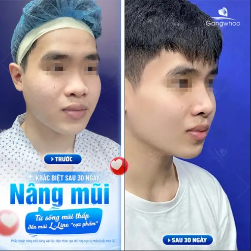 Vì sao đu đủ thường được khuyến khích ăn sau nâng mũi?