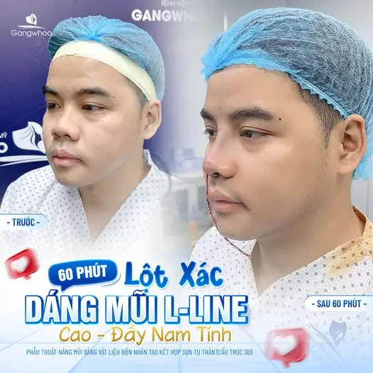 Sau nâng mũi nên ăn đu đủ như thế nào?