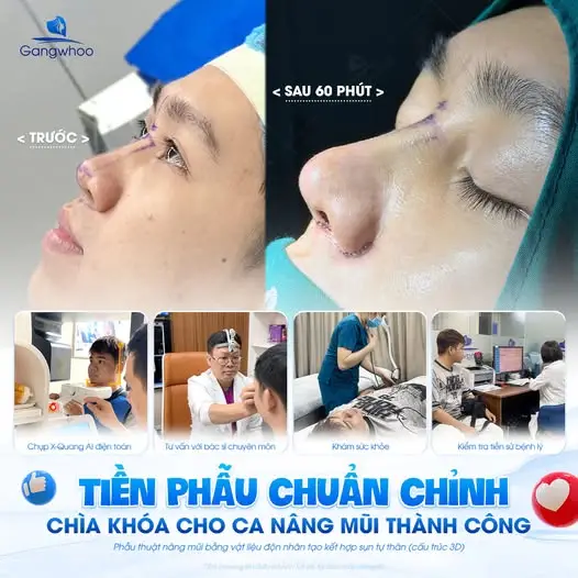 Thẩm mỹ viện Gangwhoo với quy trình chăm sóc sau nâng mũi tận tình chu đáo
