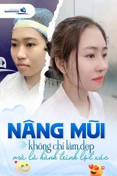 Nếu lỡ ăn mực sau nâng mũi có sao không?