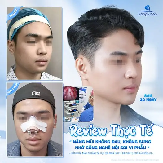 Thẩm mỹ viện Gangwhoo hiện được nhiều khách hàng quan tâm nhờ ứng dụng công nghệ nâng mũi hiện đại