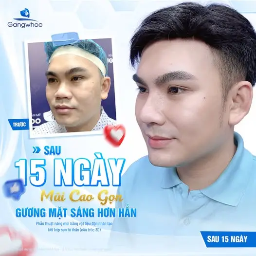 Vì sao nhiều người lo lắng khi ăn nước mắm sau khi nâng mũi?