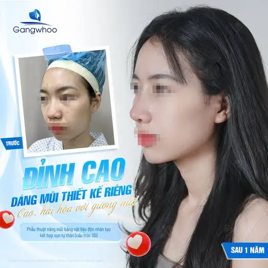 Khi nào nên hạn chế sầu riêng sau nâng mũi?