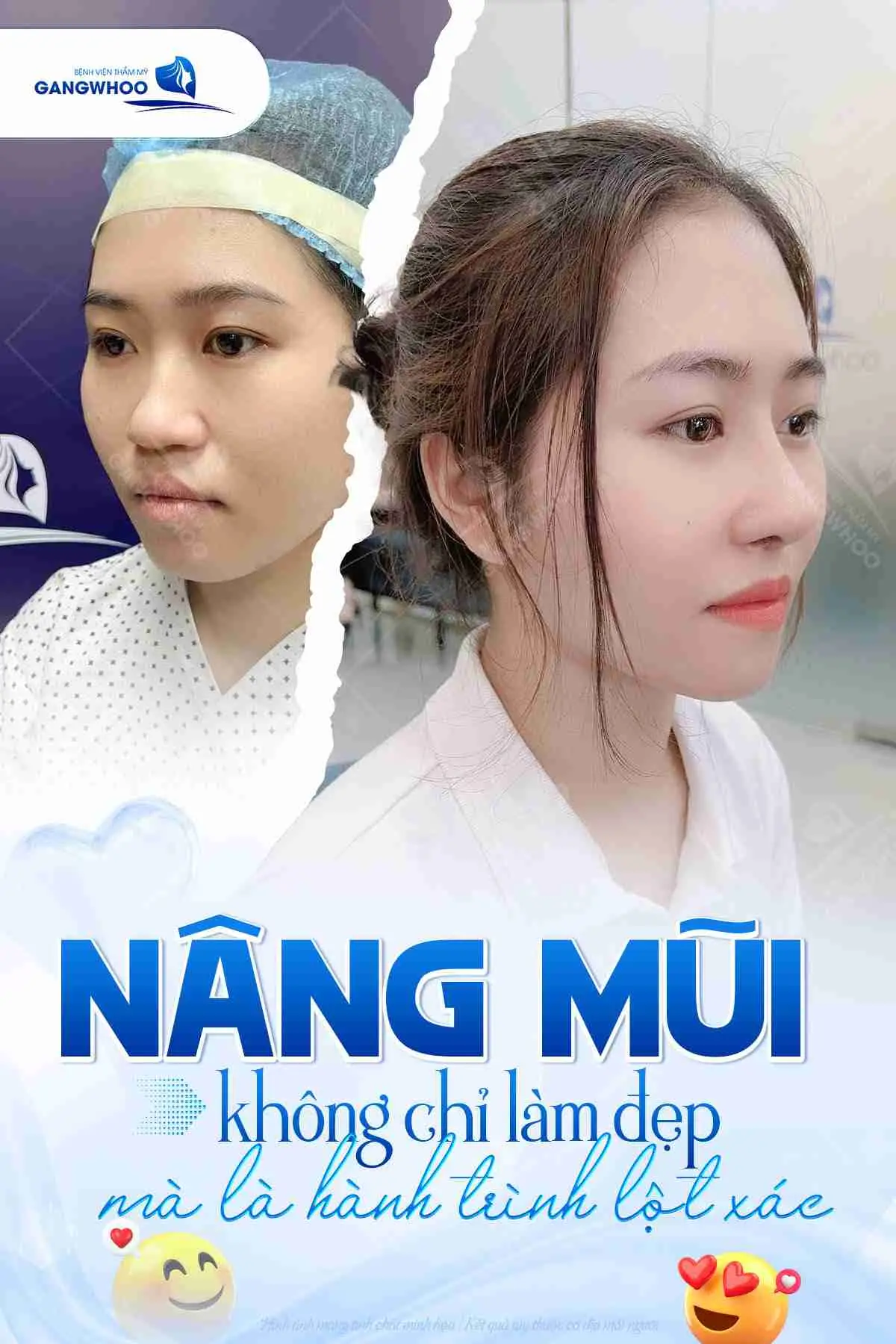 Sau nâng mũi nên ăn gì để hồi phục tốt hơn?