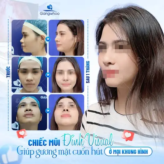 Nếu lỡ ăn xúc xích sau nâng mũi có sao không?