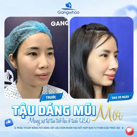 Vì sao sau khi nâng mũi thường được khuyên hạn chế cúi đầu?