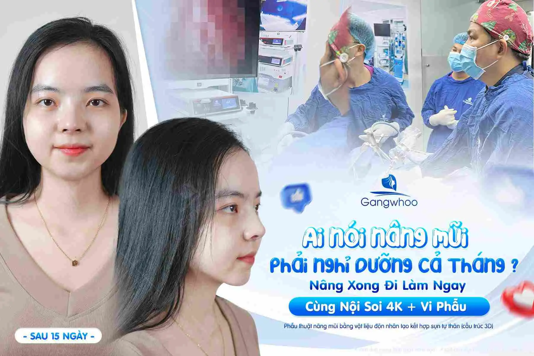 Bao lâu sau nâng mũi có thể sinh hoạt bình thường?