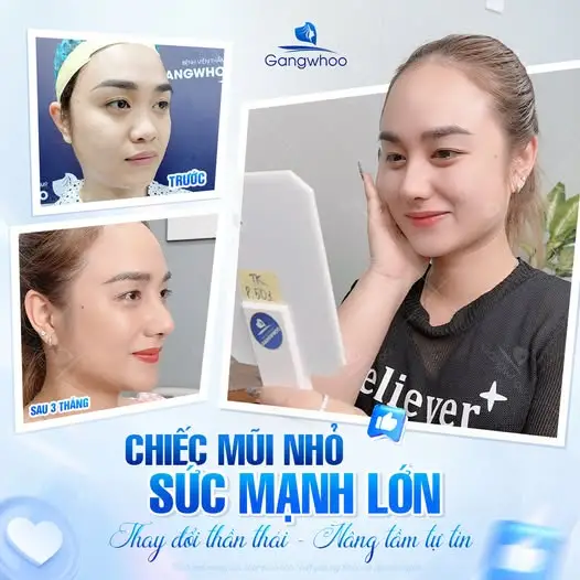 Nâng mũi có được cười không?