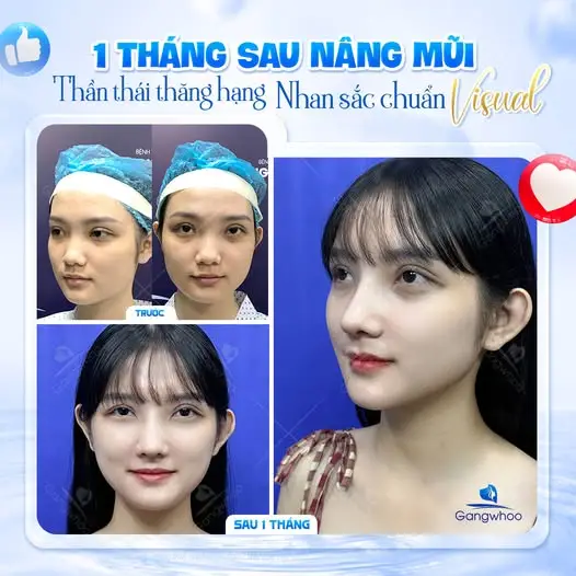 Bao lâu sau nâng mũi thì nên đi máy bay?