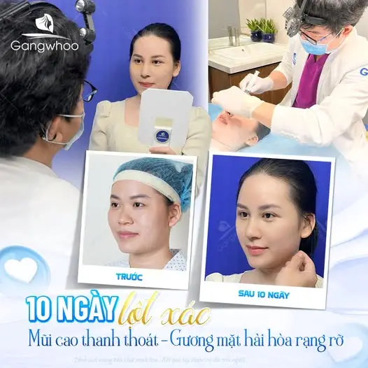 Vì sao trái cây lại quan trọng sau nâng mũi?