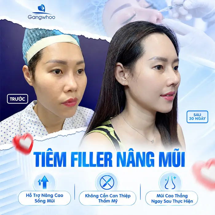 Nâng Mũi Bằng Filler Có An Toàn Không? Những Điều Cần Biết Trước Khi Tiêm