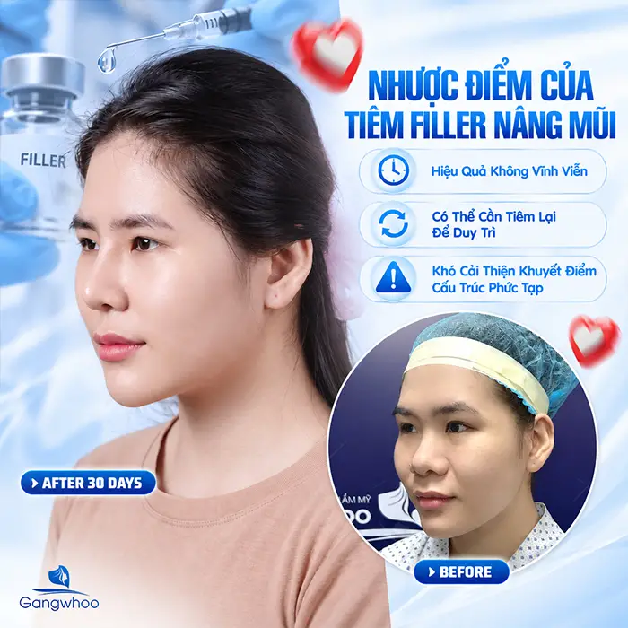 Nâng Mũi Bằng Filler Có An Toàn Không? Những Điều Cần Biết Trước Khi Tiêm