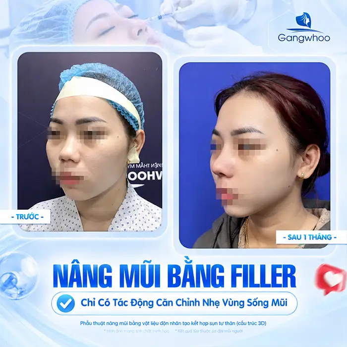 Nâng Mũi Bằng Filler Có An Toàn Không? Những Điều Cần Biết Trước Khi Tiêm