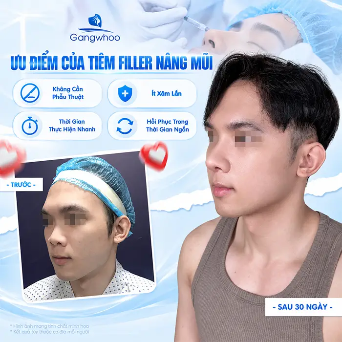 Nâng Mũi Bằng Filler Có An Toàn Không? Những Điều Cần Biết Trước Khi Tiêm