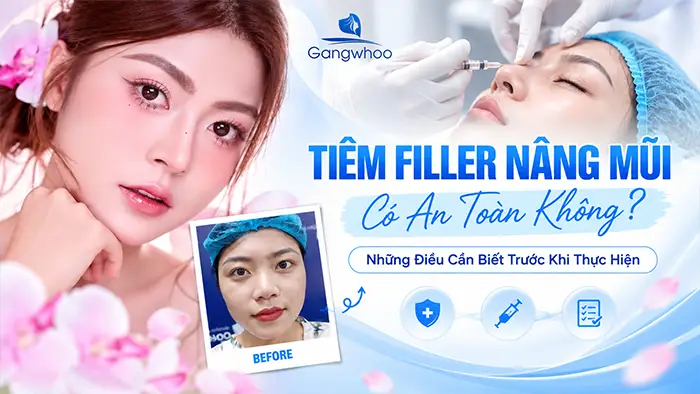 Nâng Mũi Bằng Filler Có An Toàn Không? Những Điều Cần Biết Trước Khi Tiêm