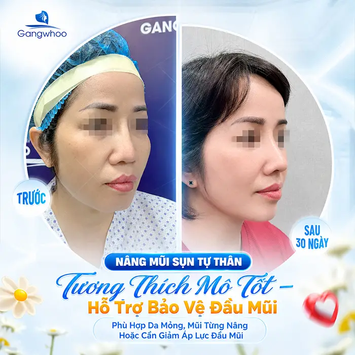 So Sánh Các Phương Pháp Nâng Mũi Phổ Biến Hiện Nay Tại Thẩm Mỹ Viện Gangwhoo