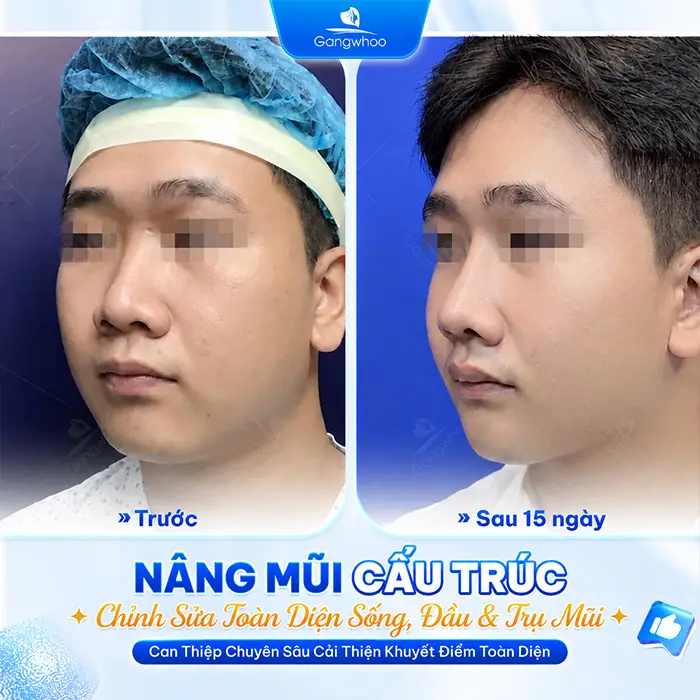 So Sánh Các Phương Pháp Nâng Mũi Phổ Biến Hiện Nay Tại Thẩm Mỹ Viện Gangwhoo
