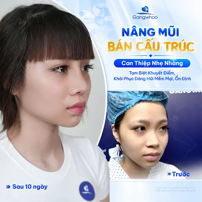 So Sánh Các Phương Pháp Nâng Mũi Phổ Biến Hiện Nay Tại Thẩm Mỹ Viện Gangwhoo
