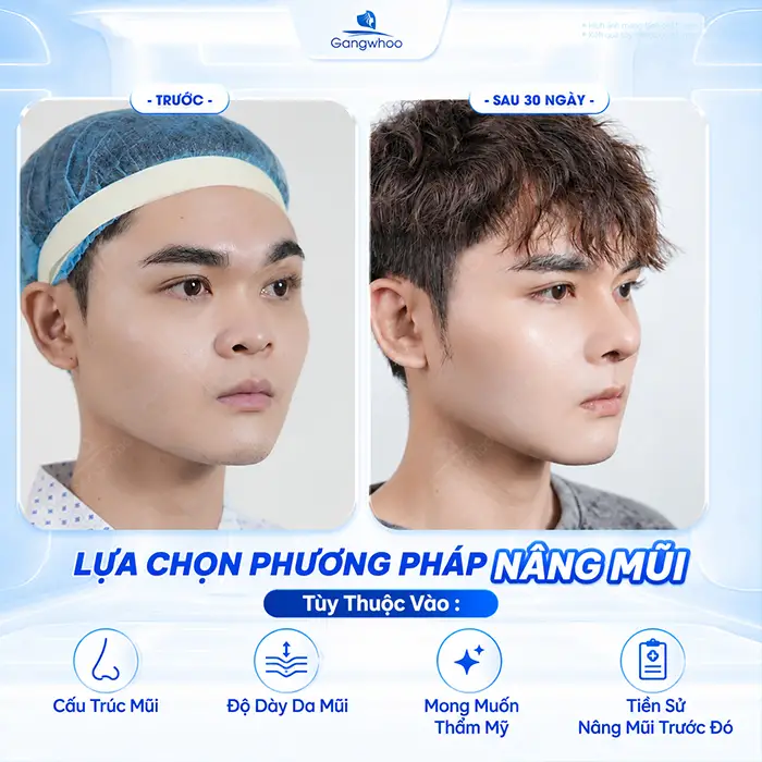 So Sánh Các Phương Pháp Nâng Mũi Phổ Biến Hiện Nay Tại Thẩm Mỹ Viện Gangwhoo