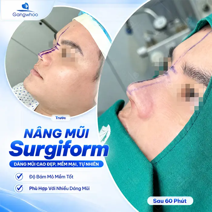 So Sánh Các Phương Pháp Nâng Mũi Phổ Biến Hiện Nay Tại Thẩm Mỹ Viện Gangwhoo
