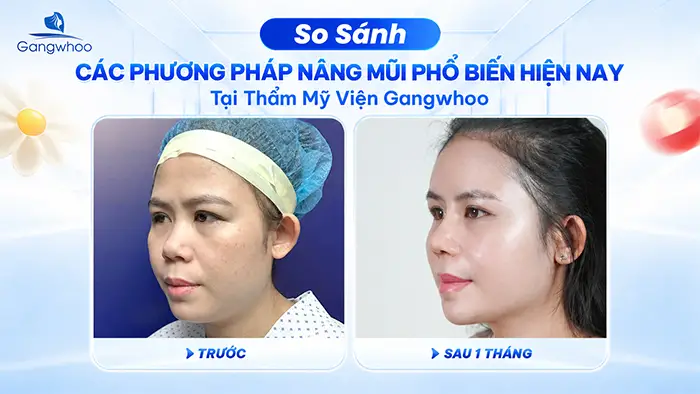 So Sánh Các Phương Pháp Nâng Mũi Phổ Biến Hiện Nay Tại Thẩm Mỹ Viện Gangwhoo