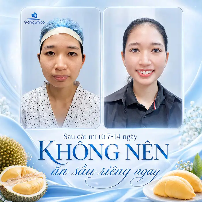 Cắt Mí Mắt Ăn Sầu Riêng Được Không? Giải Đáp Từ Bác Sĩ Thẩm Mỹ