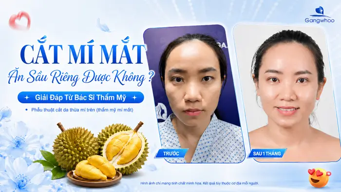 Cắt Mí Mắt Ăn Sầu Riêng Được Không? Giải Đáp Từ Bác Sĩ Thẩm Mỹ