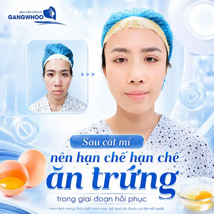 Cắt Mí Mắt Ăn Sầu Riêng Được Không? Giải Đáp Từ Bác Sĩ Thẩm Mỹ