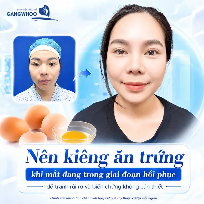Cắt Mí Mắt Ăn Sầu Riêng Được Không? Giải Đáp Từ Bác Sĩ Thẩm Mỹ