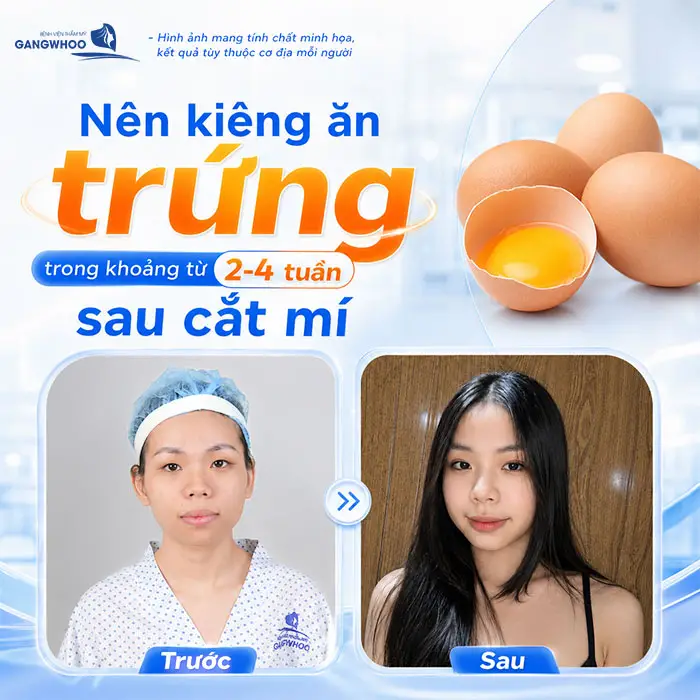 Cắt Mí Mắt Ăn Sầu Riêng Được Không? Giải Đáp Từ Bác Sĩ Thẩm Mỹ