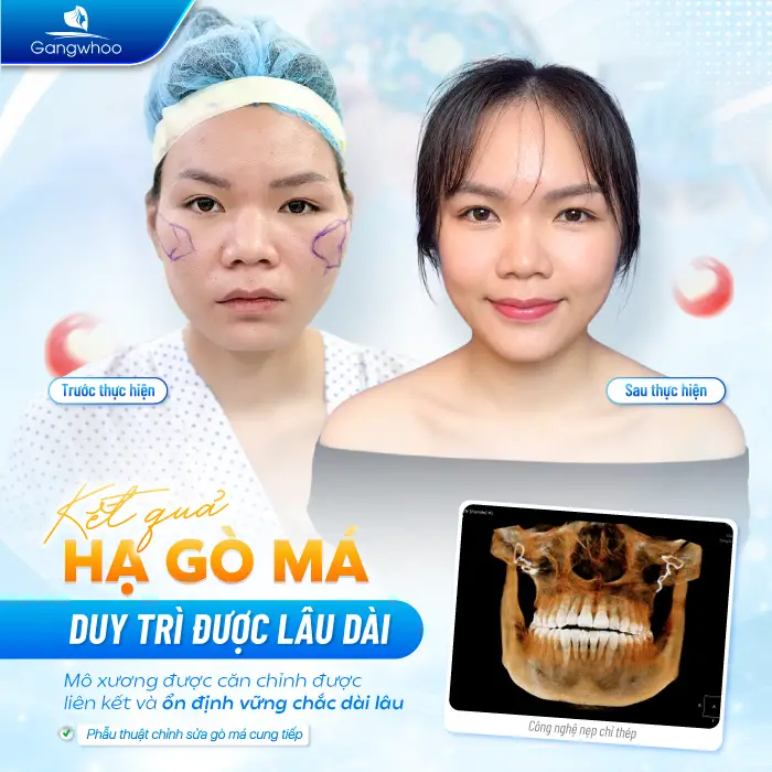 Phẫu Thuật Hạ Gò Má Có Được Vĩnh Viễn Không? Giữ Được Bao Lâu?