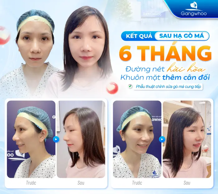 Phẫu Thuật Hạ Gò Má Có Được Vĩnh Viễn Không? Giữ Được Bao Lâu?