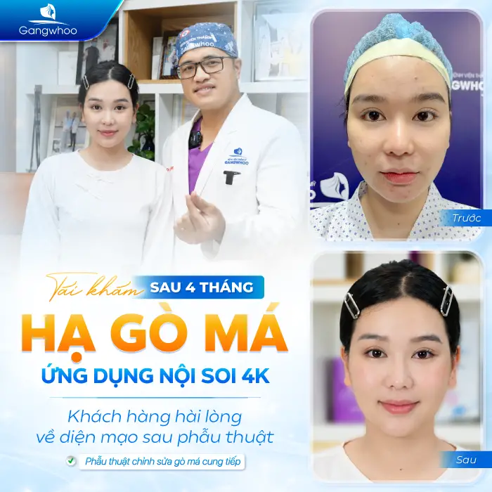 Phẫu Thuật Hạ Gò Má Có Được Vĩnh Viễn Không? Giữ Được Bao Lâu?