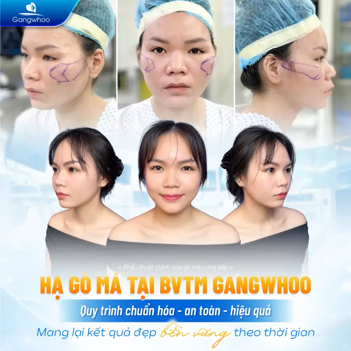 Phẫu Thuật Hạ Gò Má Có Được Vĩnh Viễn Không? Giữ Được Bao Lâu?