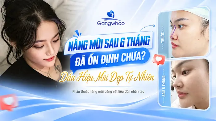 Nâng Mũi Sau 6 Tháng Đã Ổn Định Chưa? Dấu Hiệu Mũi Đẹp Tự Nhiên