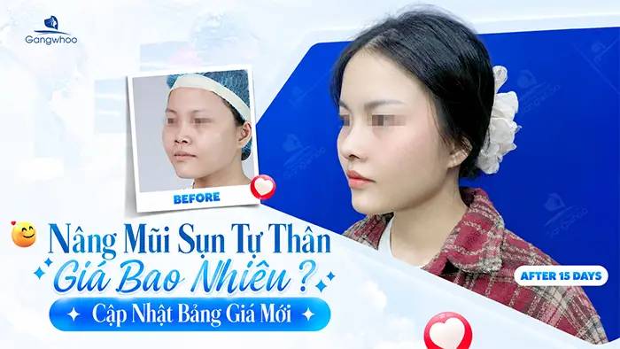 Nâng Mũi Sụn Tự Thân Giá Bao Nhiêu? Cập Nhật Bảng Giá Mới