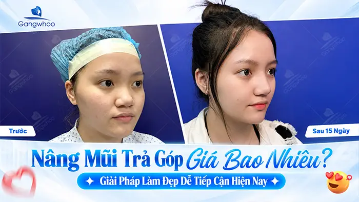Nâng Mũi Trả Góp Giá Bao Nhiêu? Giải Pháp Làm Đẹp Dễ Tiếp Cận Hiện Nay