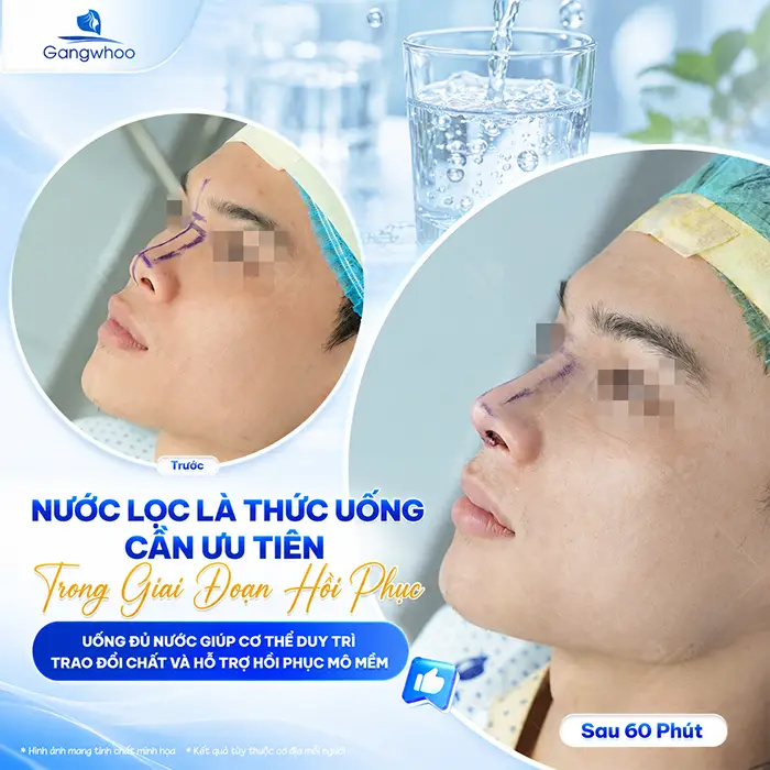 Nâng Mũi Uống Gì Mau Lành? Gợi Ý Thức Uống Hỗ Trợ Hồi Phục Tốt Hơn