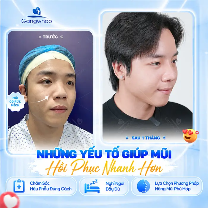 Nâng Mũi Uống Gì Mau Lành? Gợi Ý Thức Uống Hỗ Trợ Hồi Phục Tốt Hơn