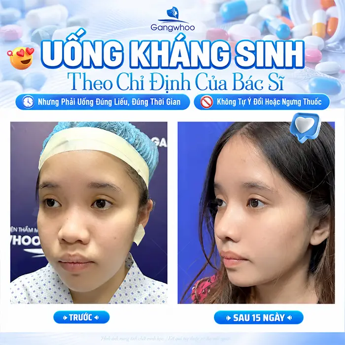 Nâng Mũi Uống Kháng Sinh Bao Lâu? Lưu Ý Khi Dùng Thuốc Sau Phẫu Thuật