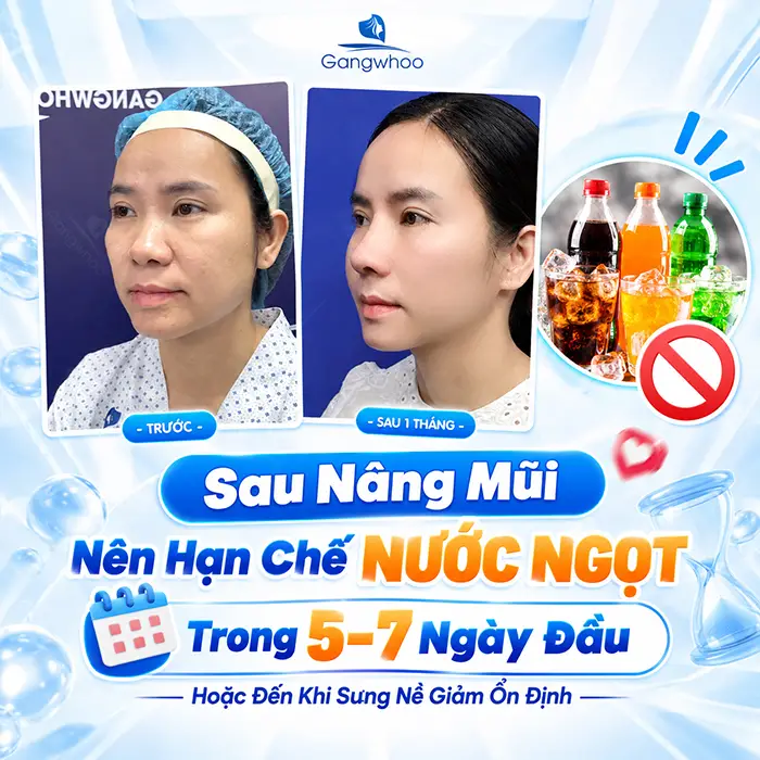 Nâng Mũi Uống Nước Ngọt Được Không? Những Lưu Ý Sau Phẫu Thuật
